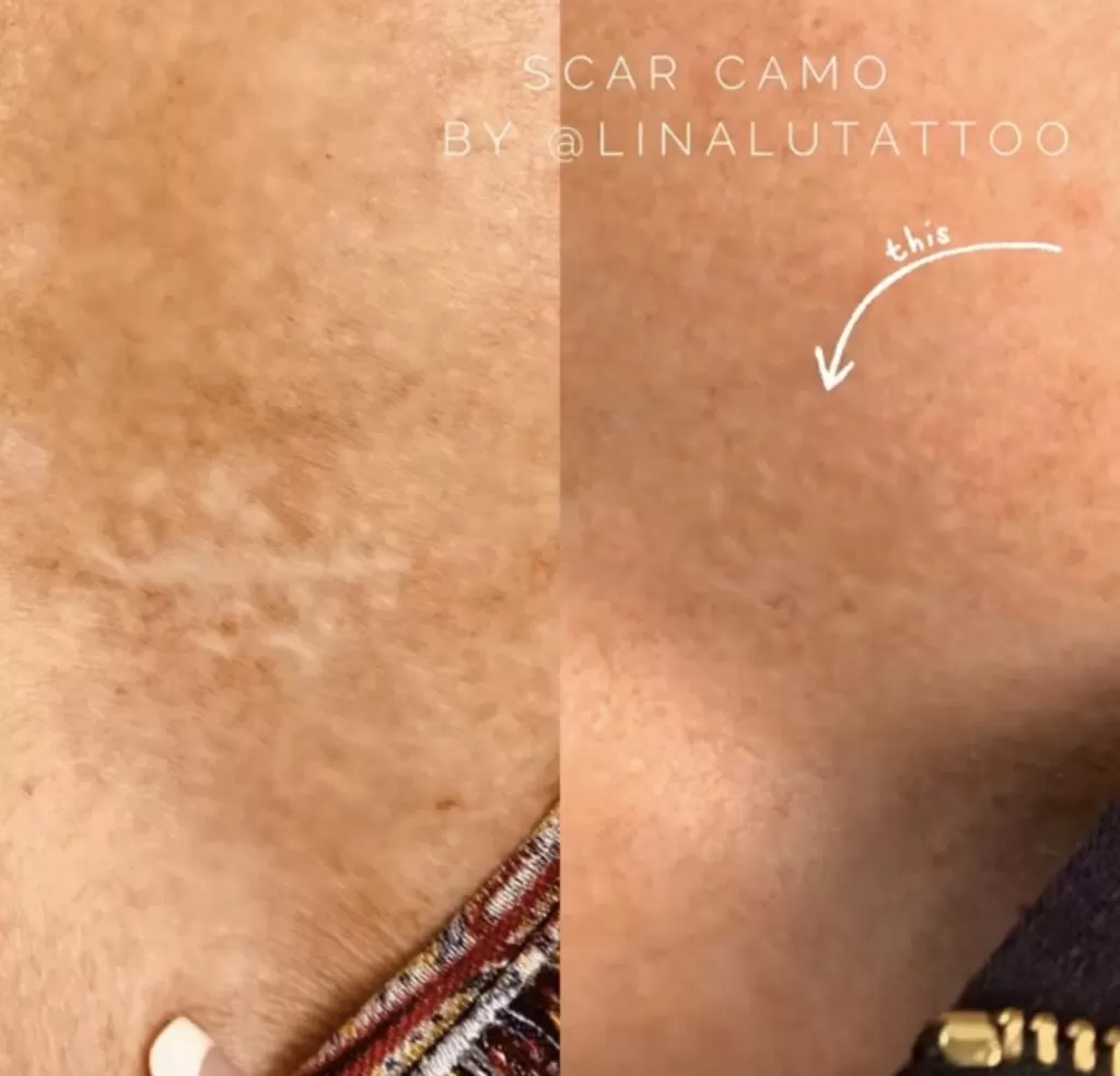 Scar Camouflage - Skincare & Cosmetics | Auburn, CA
